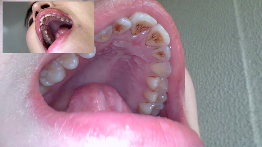 「【口腔観察】歯・舌・喉をじっくり接写！素人4名の口内フェチ動画55分セット」のサンプル画像7枚目